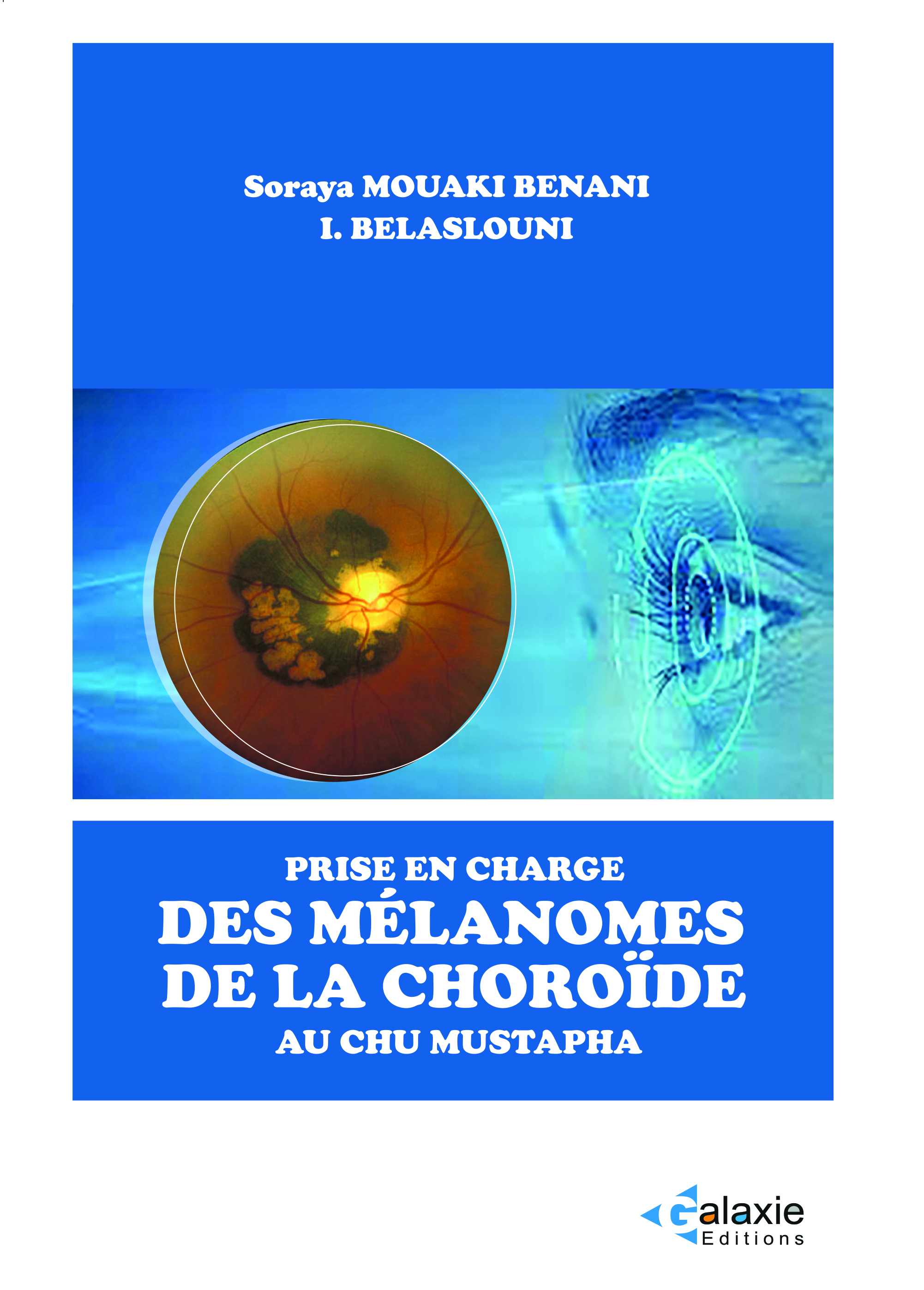 prise en charge des MELANOMES DE LA CHOROÏDE au CHU Mustapha